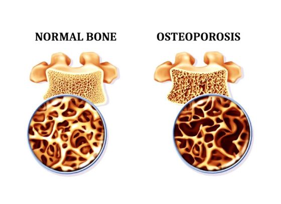 অস্টিওপোরোসিসের সাতকাহন