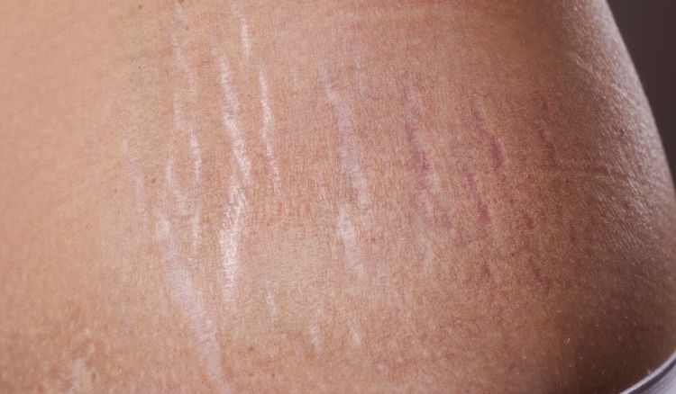 How to reduce stretch mark from skin