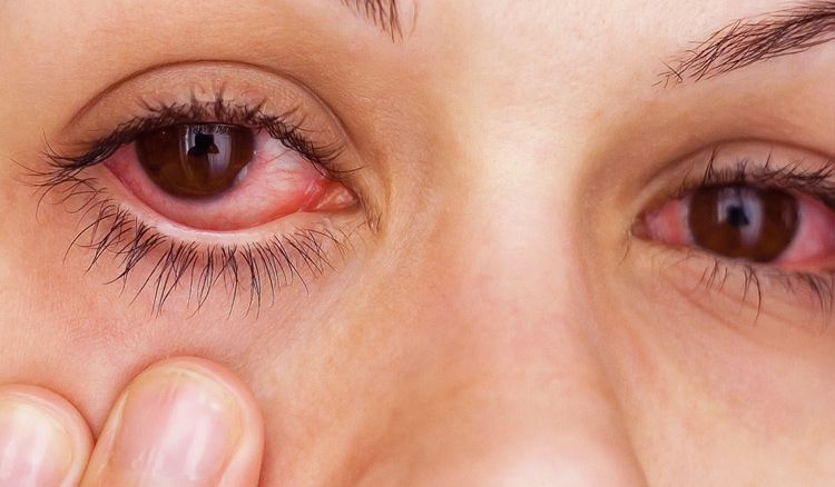 The problems of Conjunctivitis