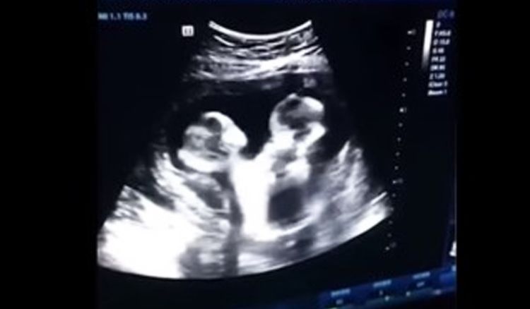 Unborn twin babies fighting inside mother’s womb