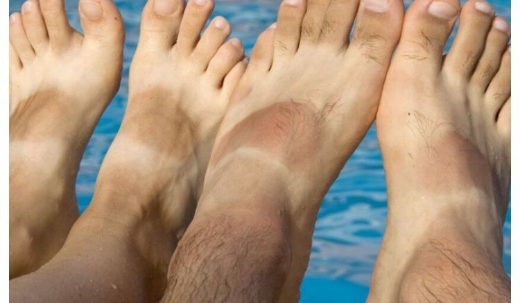 Home remedy to reduce sun tan in foot