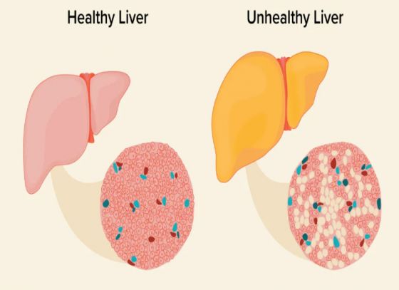কেন হয় ফ্যাটি লিভার?