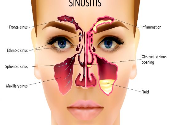 সাইনুসাইটিস কেন হয় জানেন?