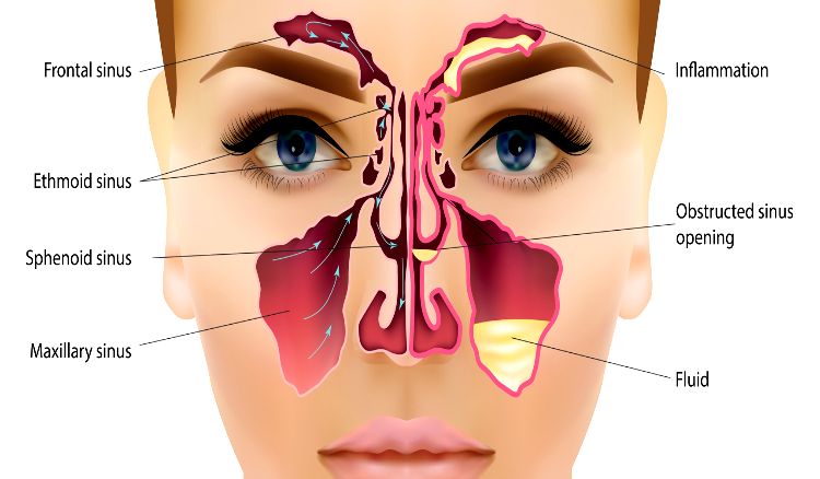 Sinusitis symptoms & Treatment